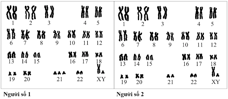 Để tìm hiểu về một hội chứng di truyền, người ta đã so sánh bộ nhiễm sắc thể của một người bình thường và một người mắc hội chứng (người số 1